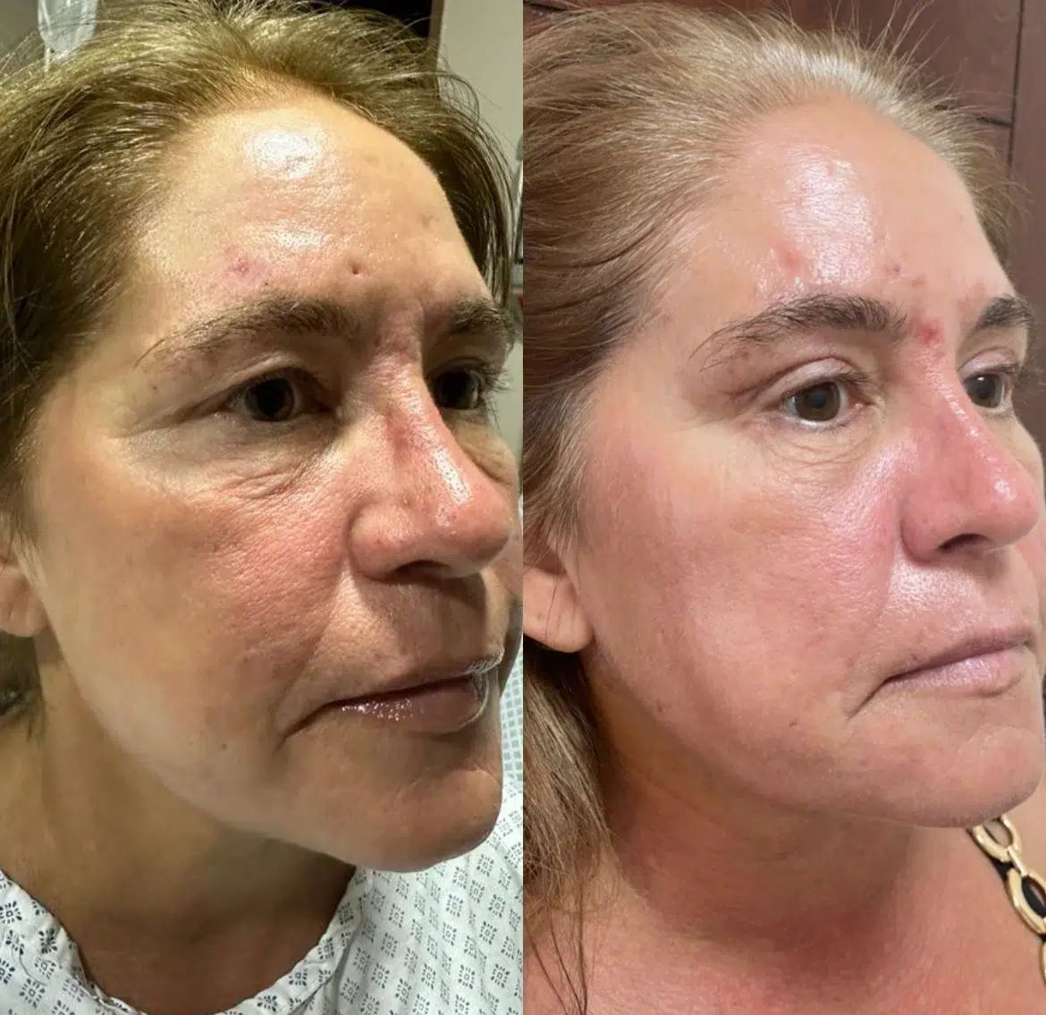 Resultado real de blefaroplastia en Zapopan con el Dr. Castellanos