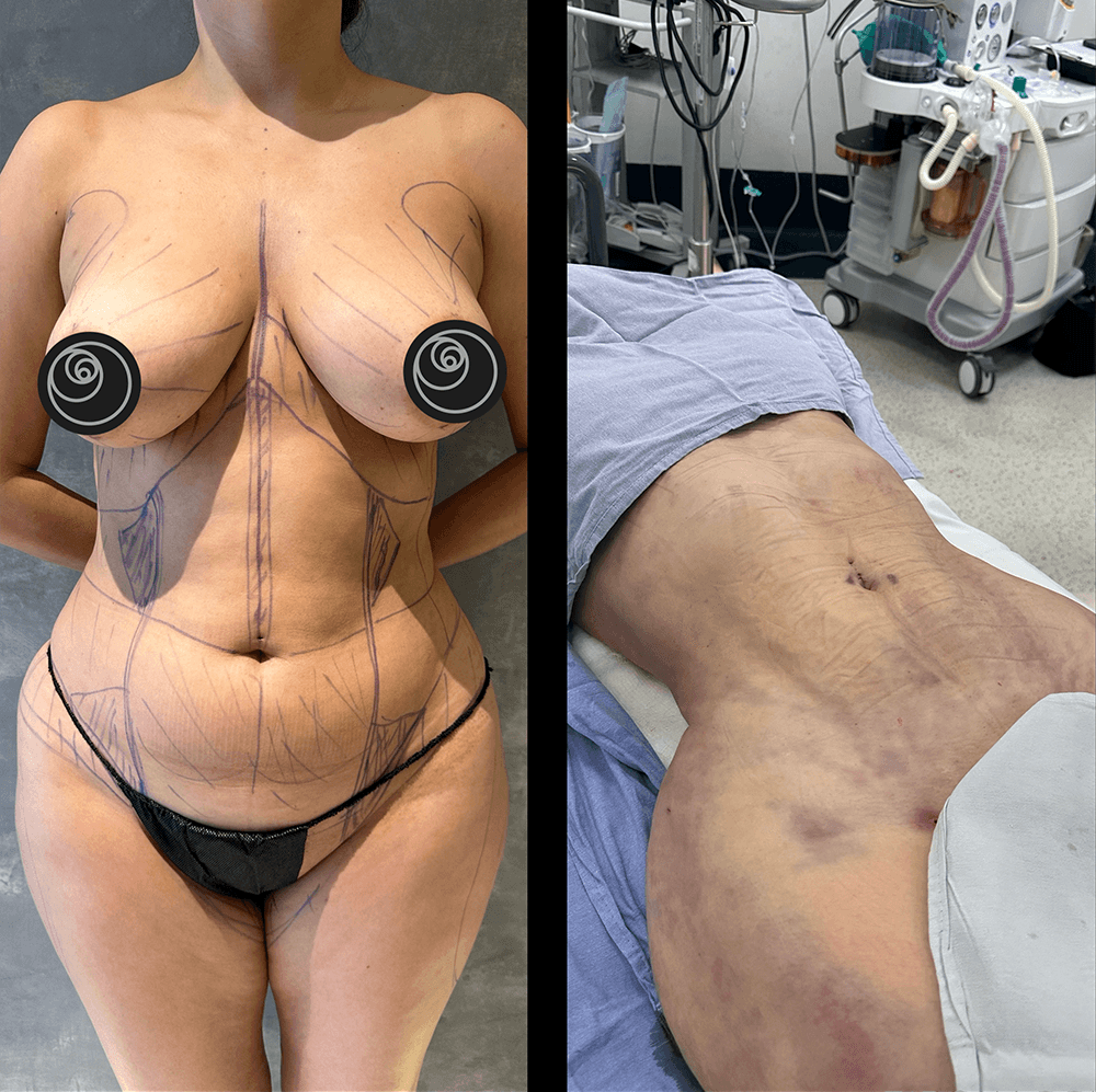 Resultado real de liposucción con el Dr. Castellanos