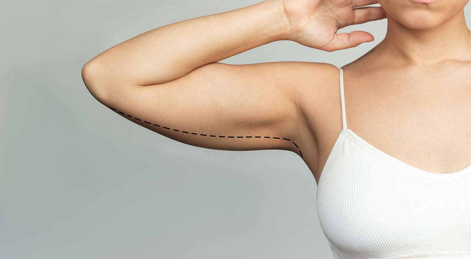 young woman with excess fat on her upper arm with marks for liposuction